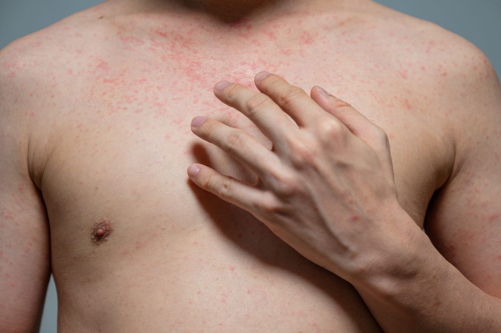 Dermatitis rash viral disease with immunodeficiency on body of y